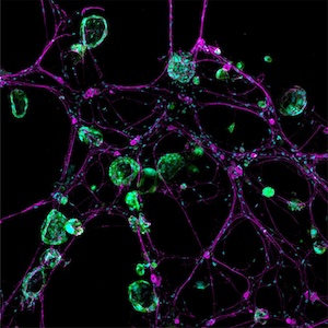 يُظهر نموذج ثلاثي الأبعاد كيف تتواصل الخلايا العصبية (باللون الأرجواني) مع الخلايا السرطانية (باللون الأخضر).